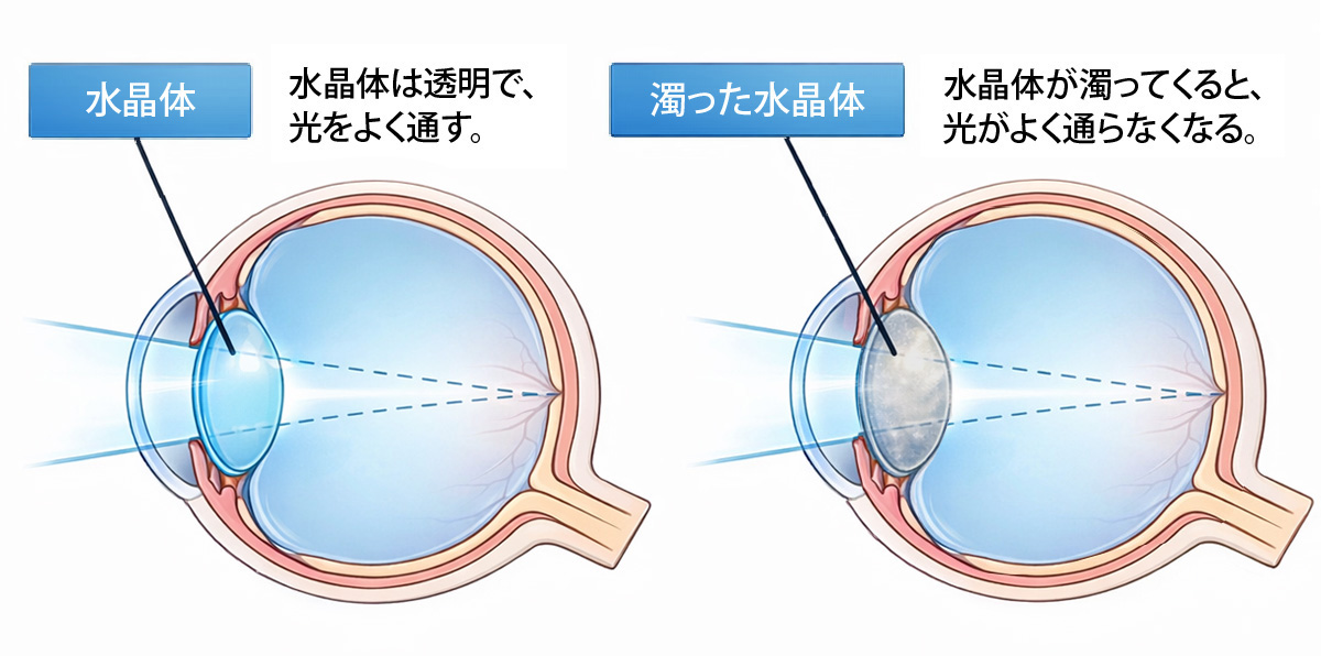 白内障イメージ