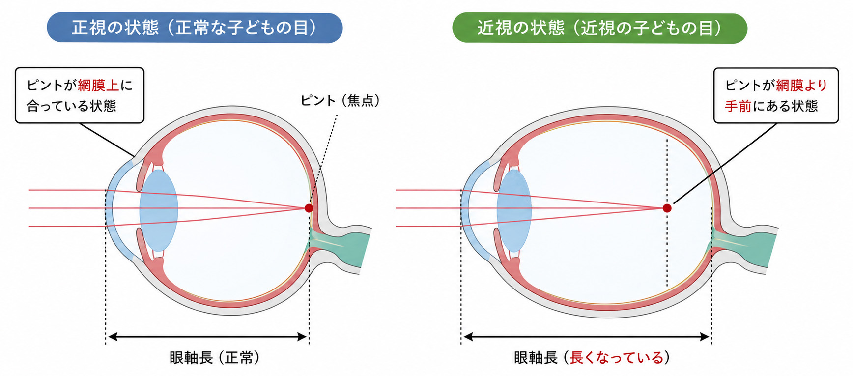 子どもの近視